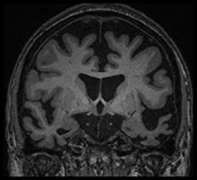 Relearning and Retaining Personally-Relevant Words using Computer-Based Flashcard Software in Primary Progressive Aphasia